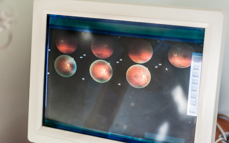 Dry AMD Emerging Therapies in Therapeutics Market Pegcetacoplan and Zimura