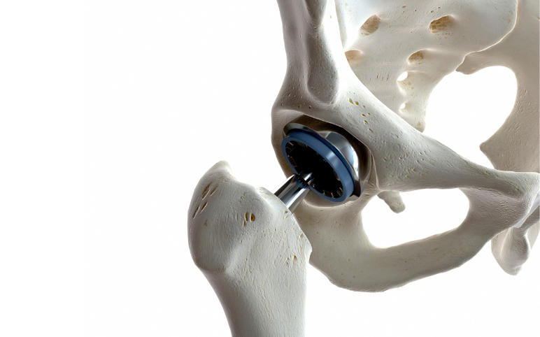 Orthopedic Implants Market Growth Analysis and Key Companies