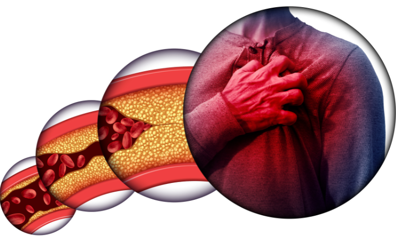apociii-inhibitors-for-shtg-and-fcs-treatment
