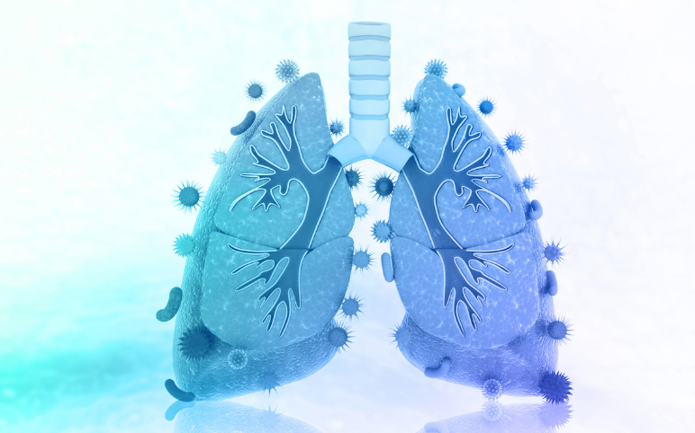 emerging-therapies-for-non-cystic-fibrosis-bronchiectasis-treatment