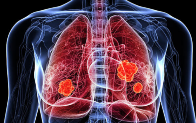 How Emerging Pipeline Therapies Will Unfold the Severe Asthma Tre...