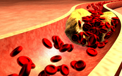 PCSK9 Inhibitors: A New Era for Cholesterol Management